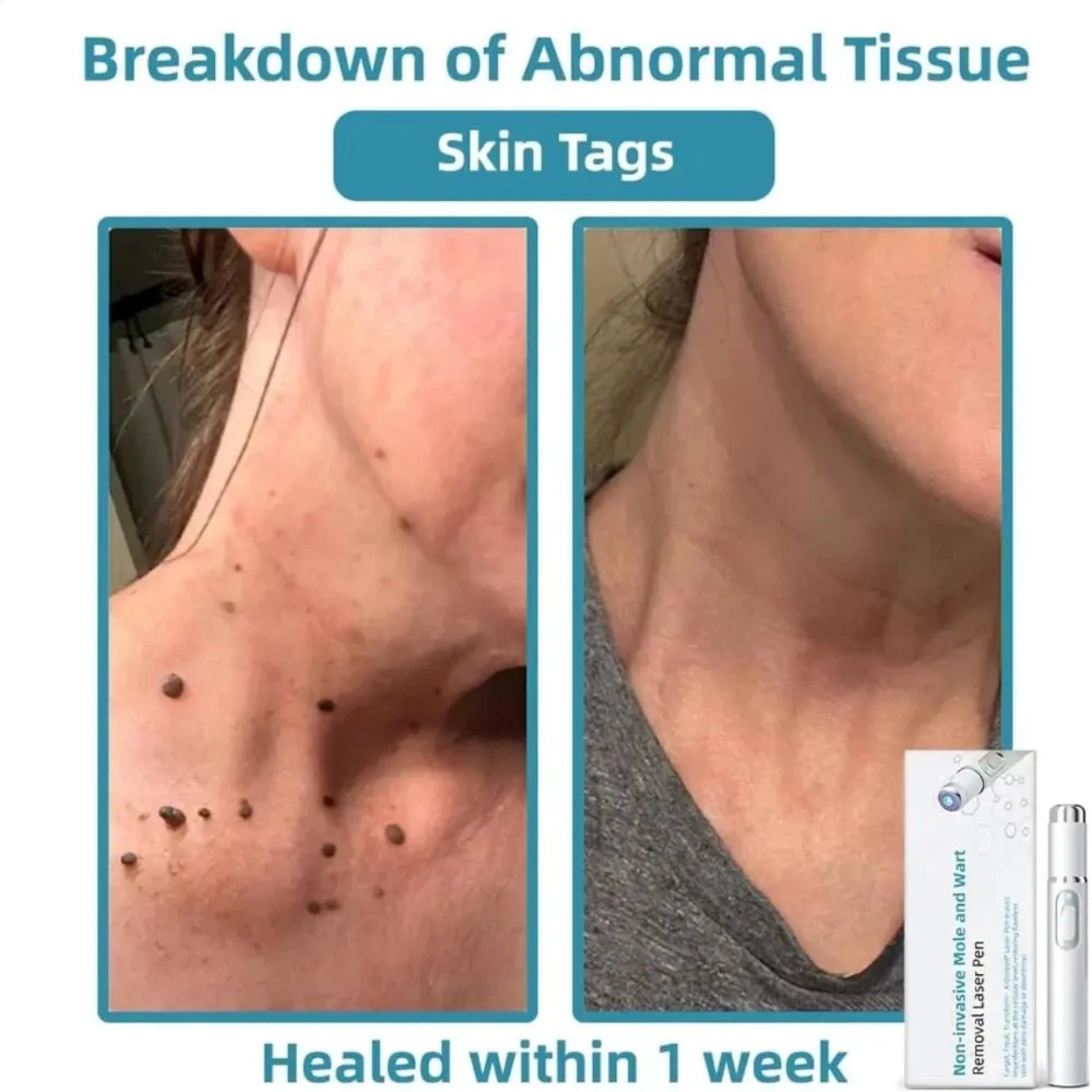 Glowzen - Laser Mole & Skin Tag Remover