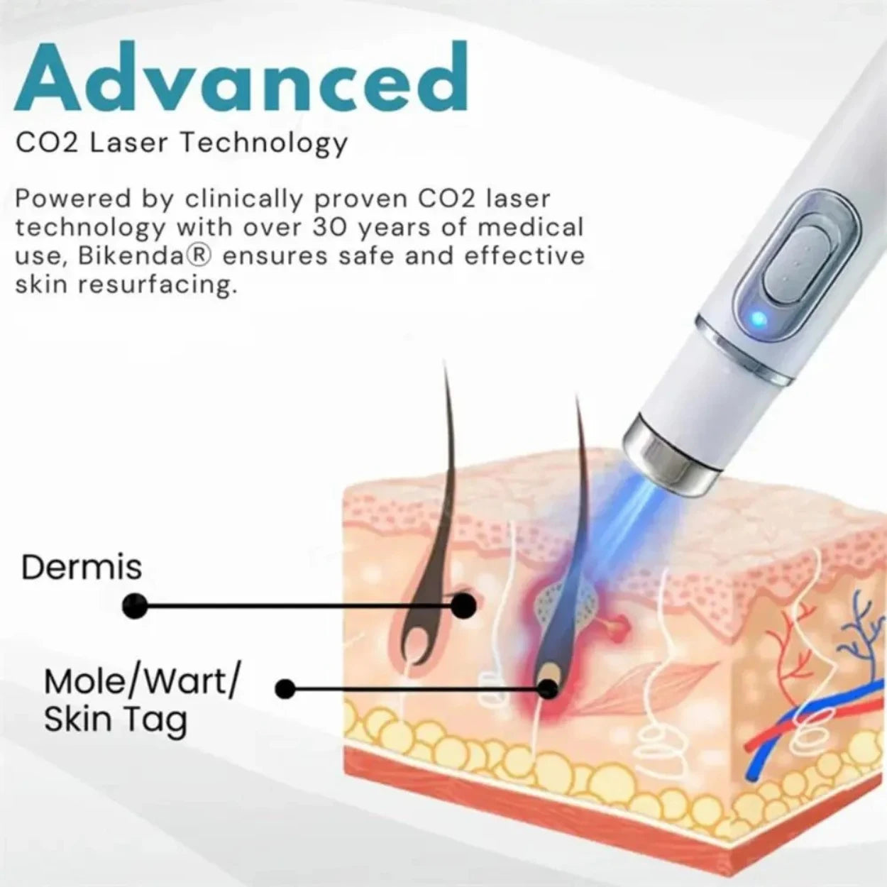 Glowzen - Laser Mole & Skin Tag Remover