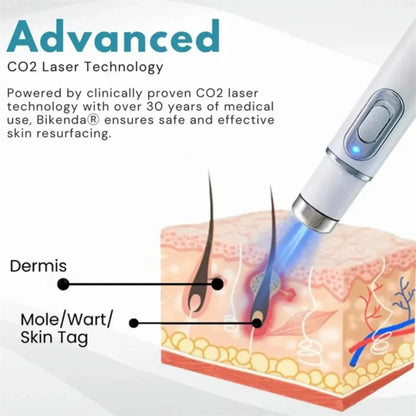 Glowzen - Laser Mole & Skin Tag Remover