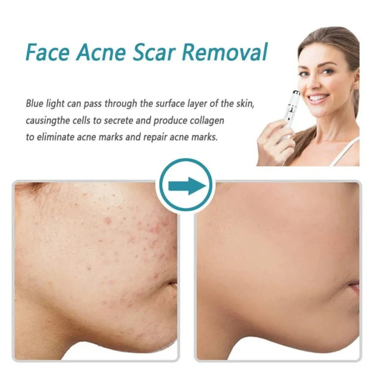 Glowzen - Laser Mole & Skin Tag Remover