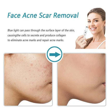 Glowzen - Laser Mole & Skin Tag Remover